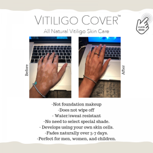 vitiligo cover lotion owner nathalie pelletier