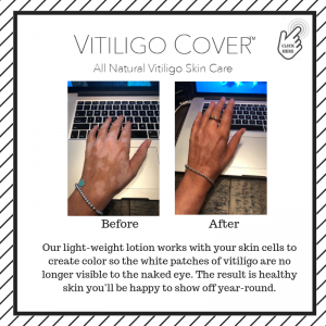 2022 vitiligo cover lotion 